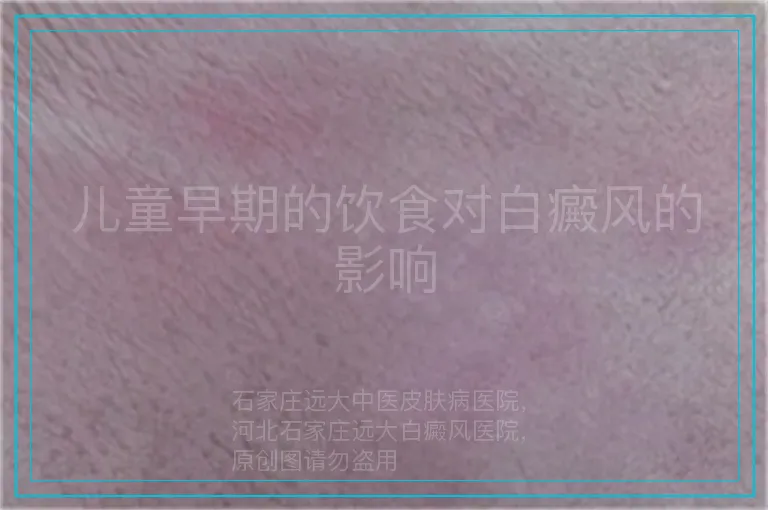 儿童早期的饮食对白癜风的影响