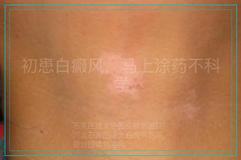 初患白癜风，马上涂药不科学