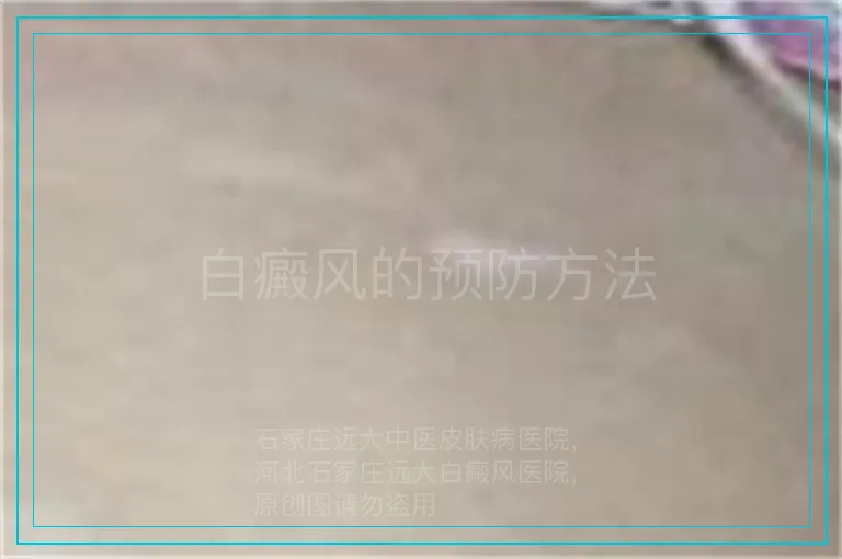 白癜风的预防方法