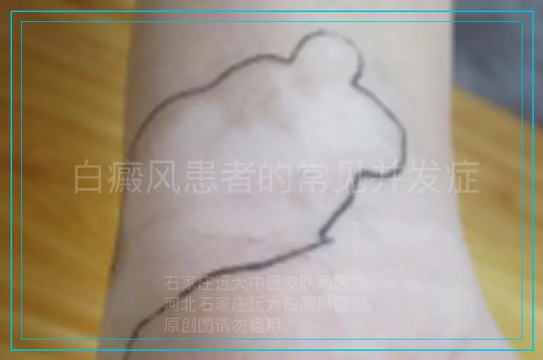 白癜风患者的常见并发症
