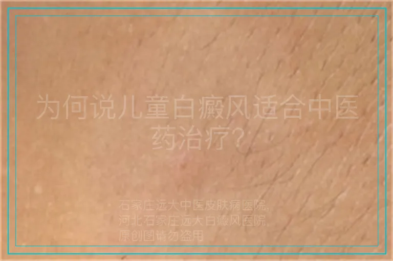 为何说儿童白癜风适合中医药治疗？