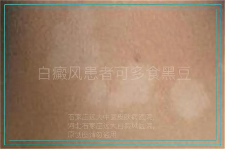 白癜风患者可多食黑豆