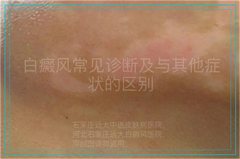 白癜风常见诊断及与其他症状的区别