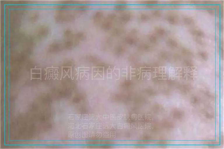 白癜风病因的非病理解释