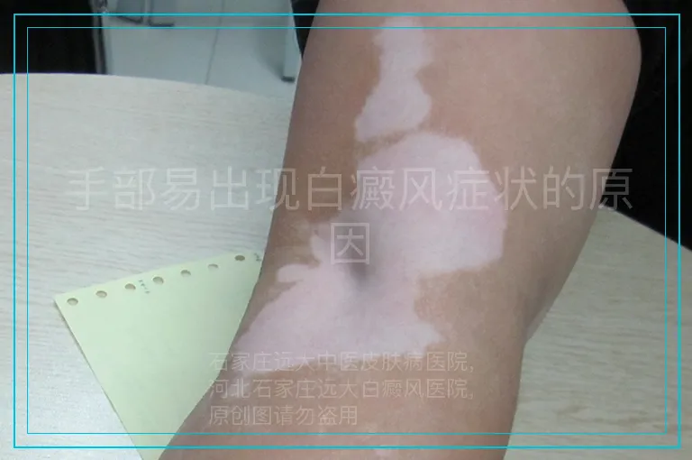 手部易出现白癜风症状的原因