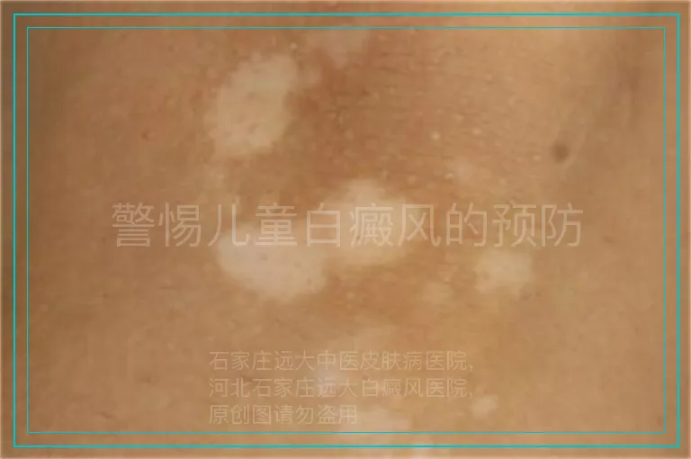 警惕儿童白癜风的预防