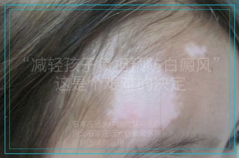 “减轻孩子负担预防白癜风”这是个艰难的决定