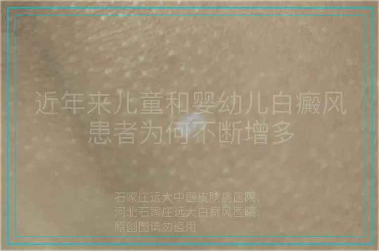 近年来儿童和婴幼儿白癜风患者为何不断增多