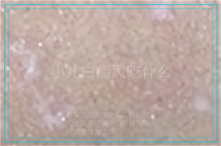 小儿白癜风吃什么