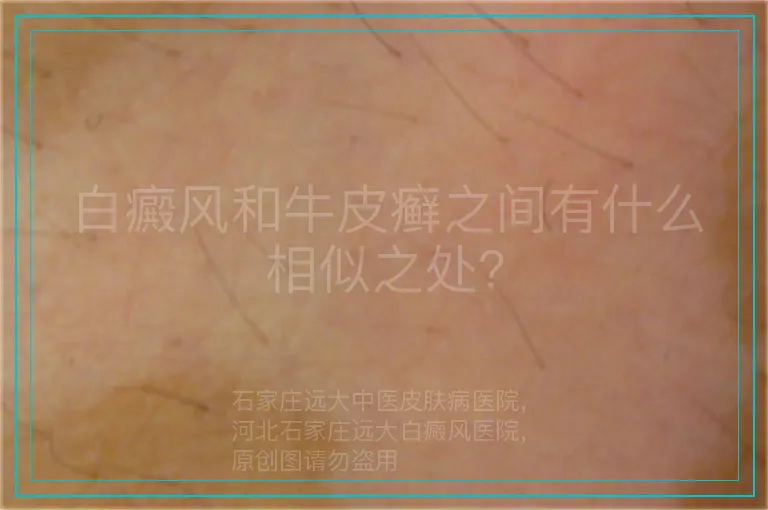 白癜风和牛皮癣之间有什么相似之处?