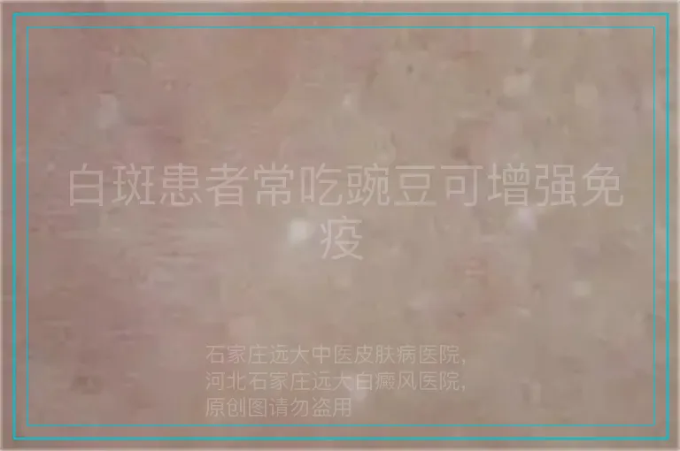 白斑患者常吃豌豆可增强免疫
