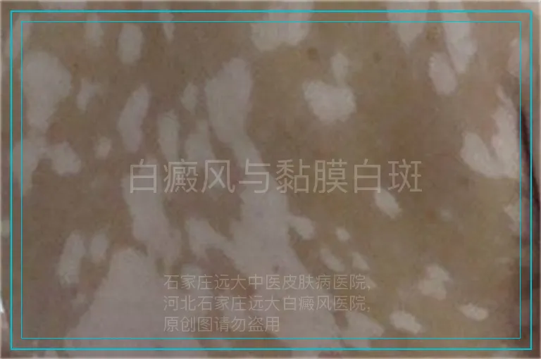 白癜风与黏膜白斑