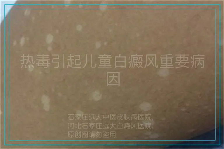 热毒引起儿童白癜风重要病因