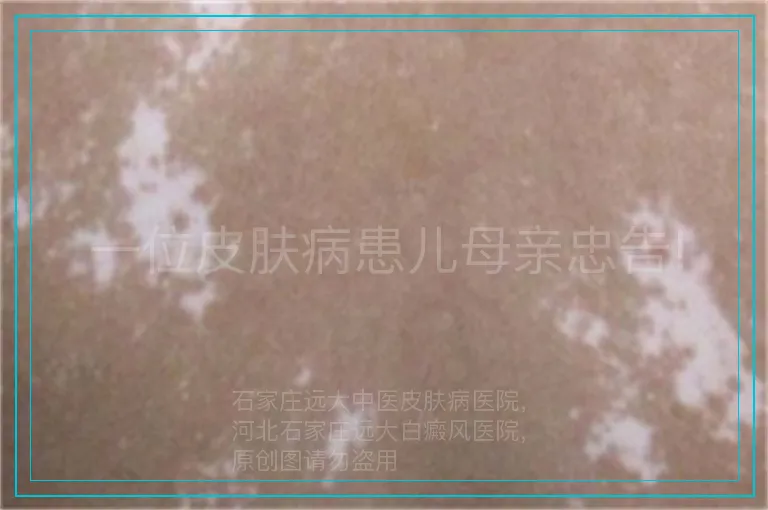 一位皮肤病患儿母亲忠告!