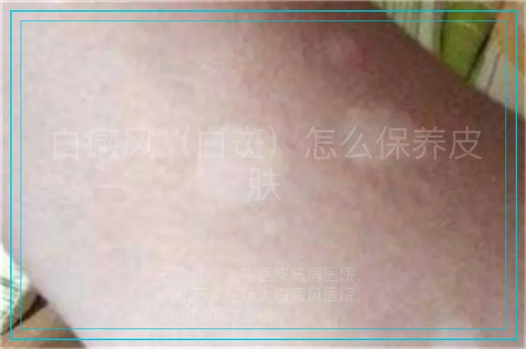 白癜风（白斑）怎么保养皮肤