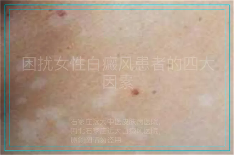 困扰女性白癜风患者的四大因素