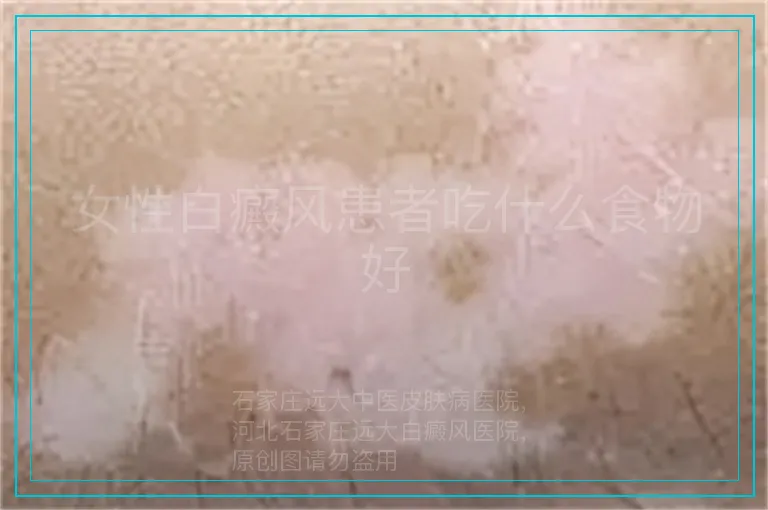女性白癜风患者吃什么食物好