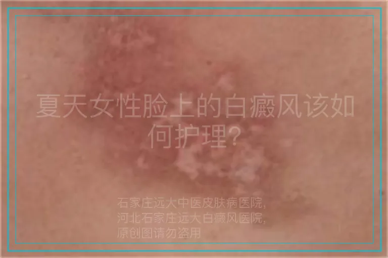 夏天女性脸上的白癜风该如何护理?