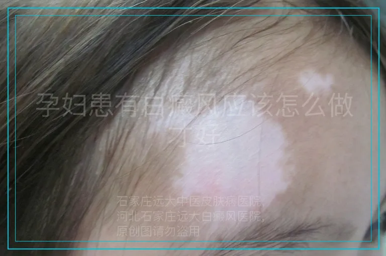 孕妇患有白癜风应该怎么做才好