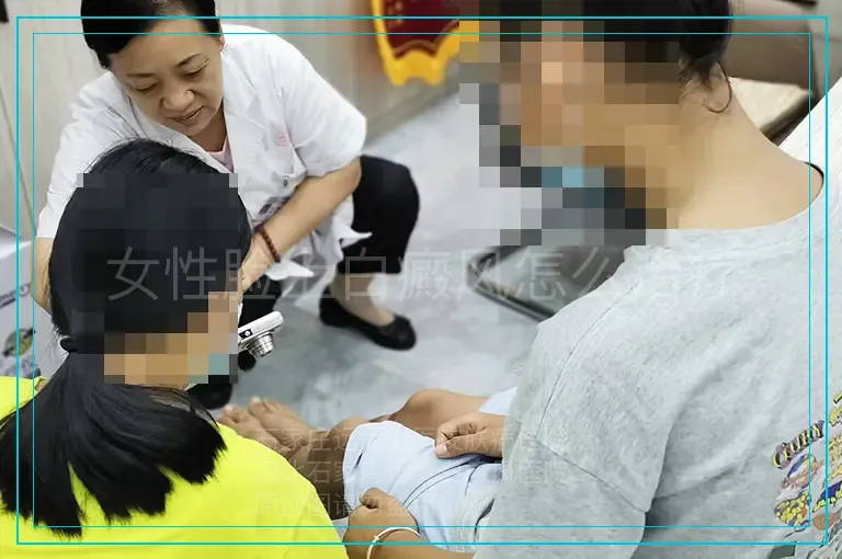 女性脸上白癜风怎么治疗