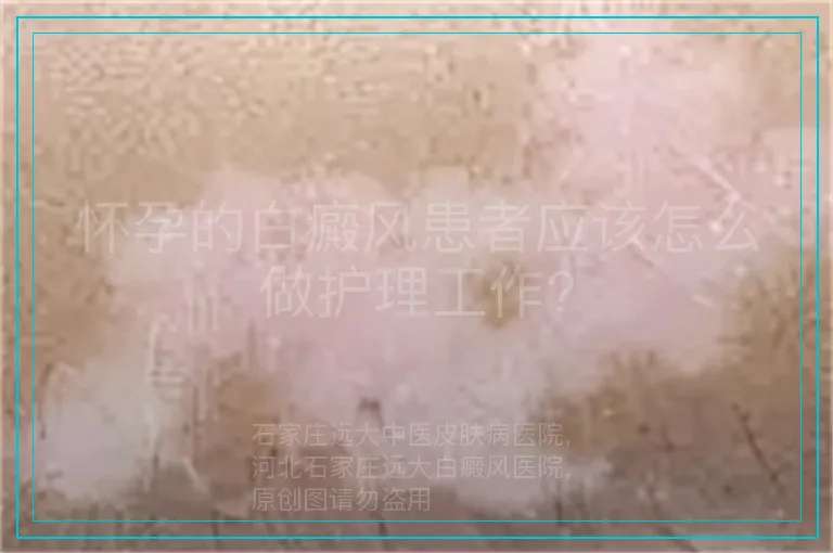 怀孕的白癜风患者应该怎么做护理工作?