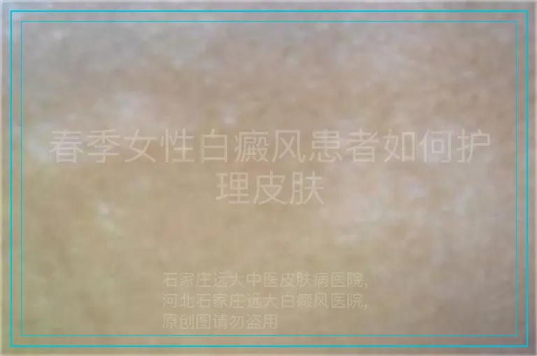 春季女性白癜风患者如何护理皮肤