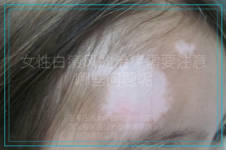 女性白癜风的治疗需要注意哪些问题呢