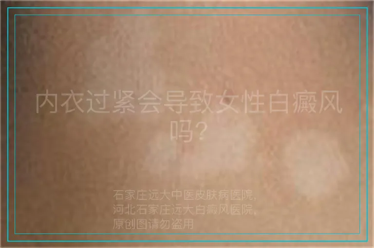 内衣过紧会导致女性白癜风吗?
