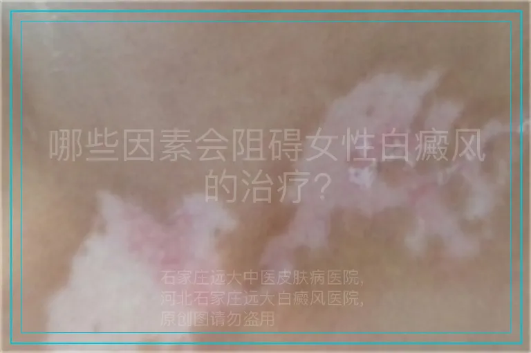 哪些因素会阻碍女性白癜风的治疗?