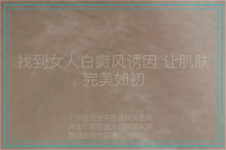找到女人白癜风诱因 让肌肤完美如初