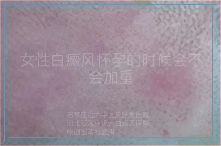 女性白癜风怀孕的时候会不会加重