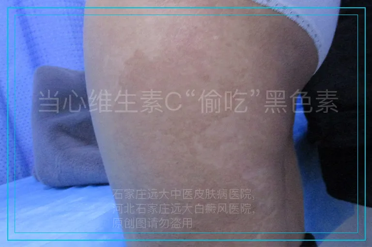 当心维生素C“偷吃”黑色素