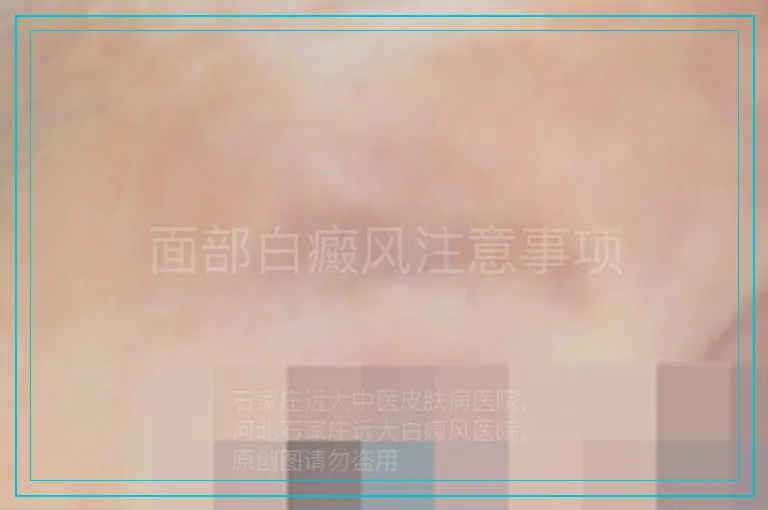 面部白癜风注意事项