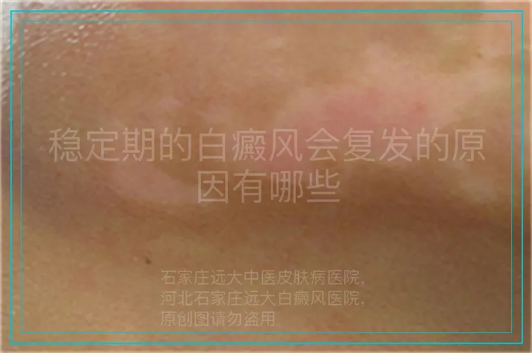 稳定期的白癜风会复发的原因有哪些
