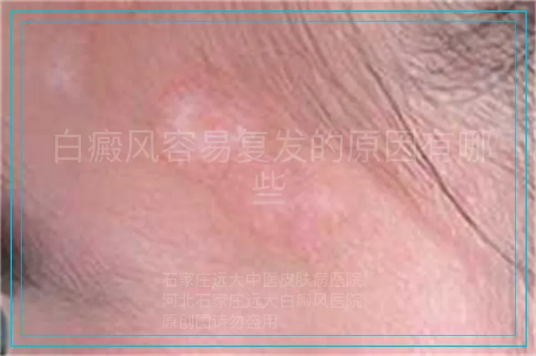 白癜风容易复发的原因有哪些