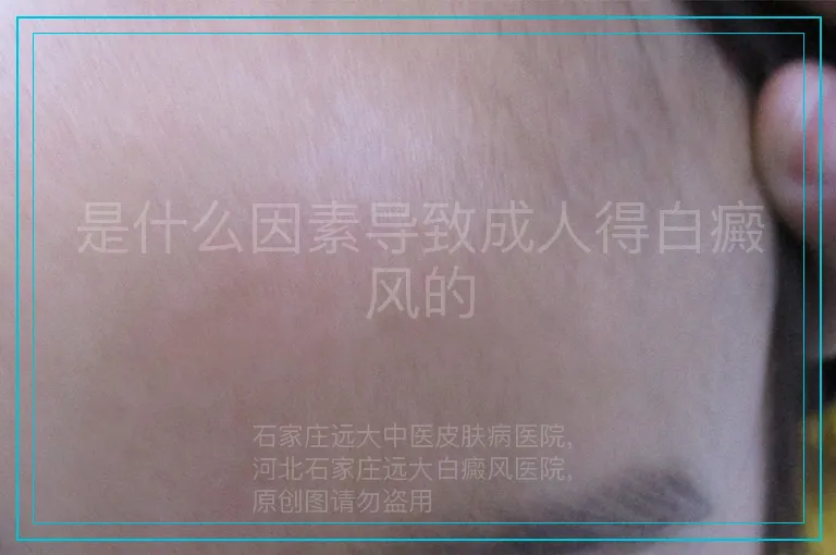 是什么因素导致成人得白癜风的