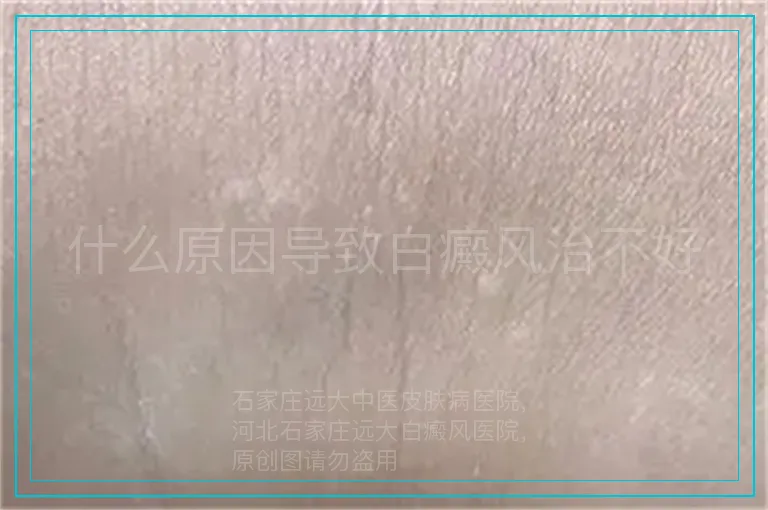 什么原因导致白癜风治不好
