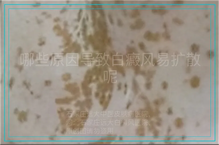 哪些原因导致白癜风易扩散呢