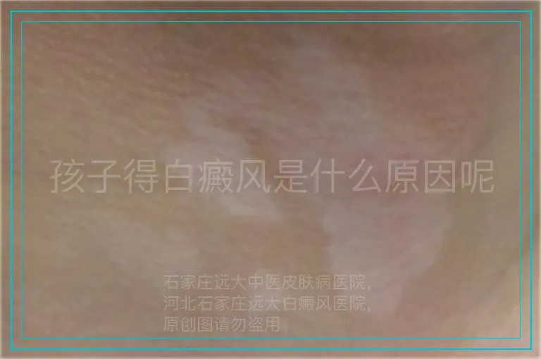 孩子得白癜风是什么原因呢