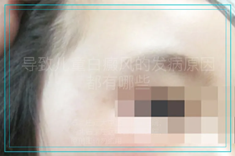 导致儿童白癜风的发病原因都有哪些