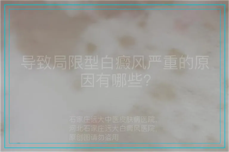 导致局限型白癜风严重的原因有哪些?
