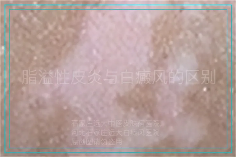 脂溢性皮炎与白癜风的区别
