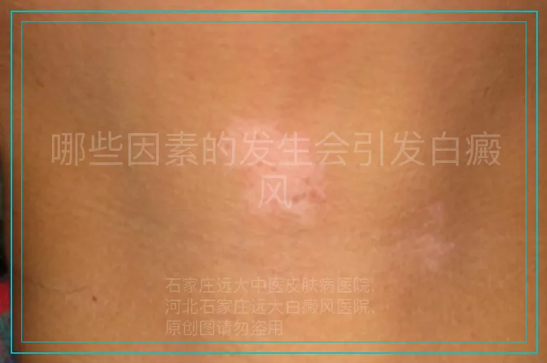 哪些因素的发生会引发白癜风