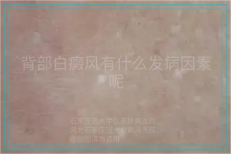 背部白癜风有什么发病因素呢