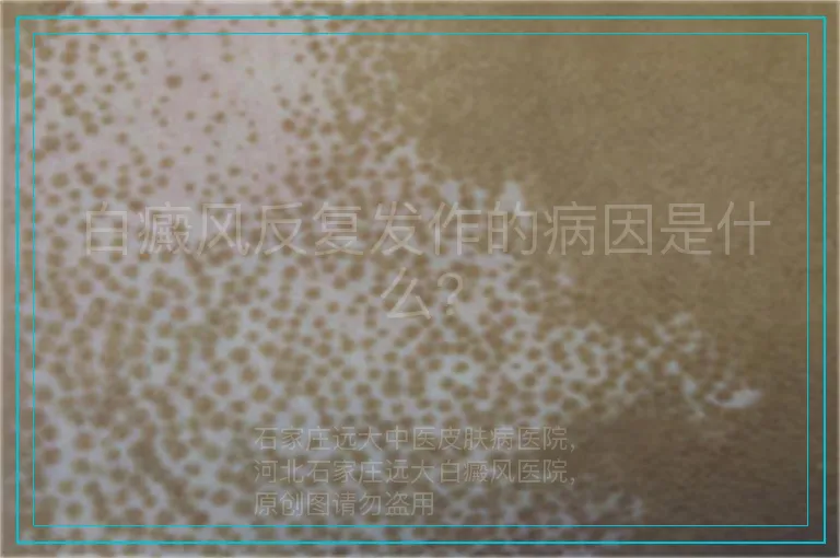 白癜风反复发作的病因是什么？