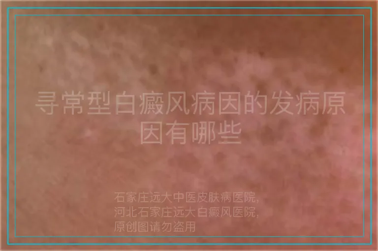 寻常型白癜风病因的发病原因有哪些
