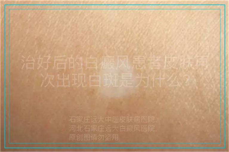 治好后的白癜风患者皮肤再次出现白斑是为什么?
