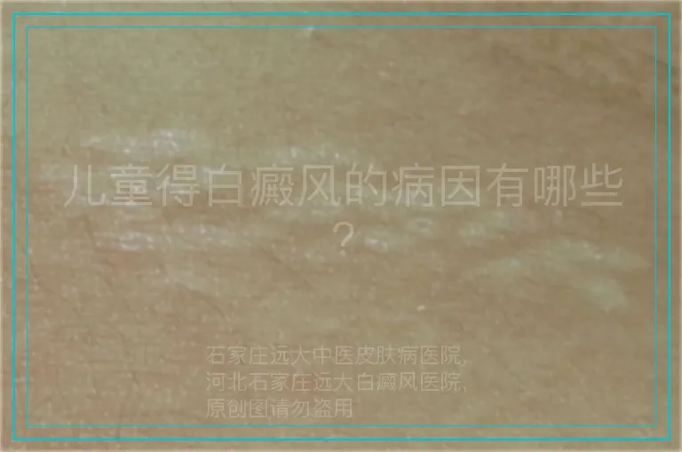 儿童得白癜风的病因有哪些?
