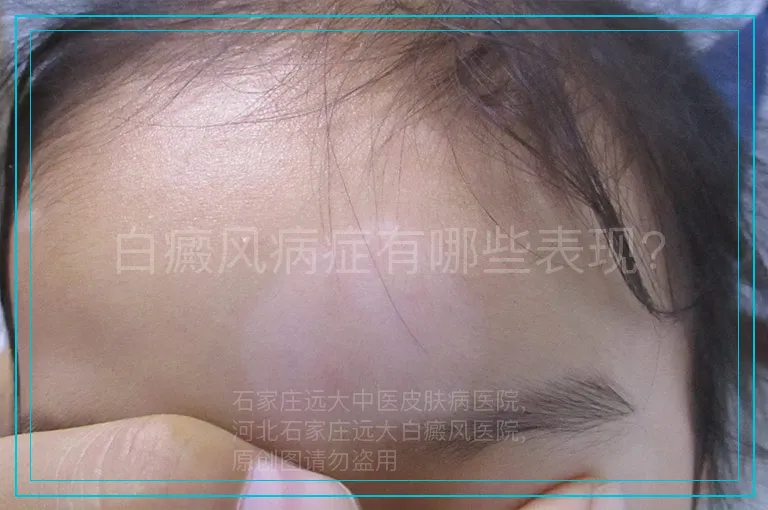 白癜风病症有哪些表现?