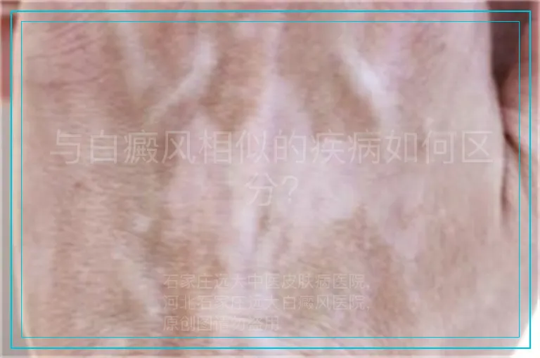 与白癜风相似的疾病如何区分?